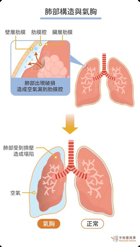 內傷會自己好嗎|肺氣、心血阻礙不暢 會引起胸部內傷｜中醫精髓｜該看哪科｜元氣